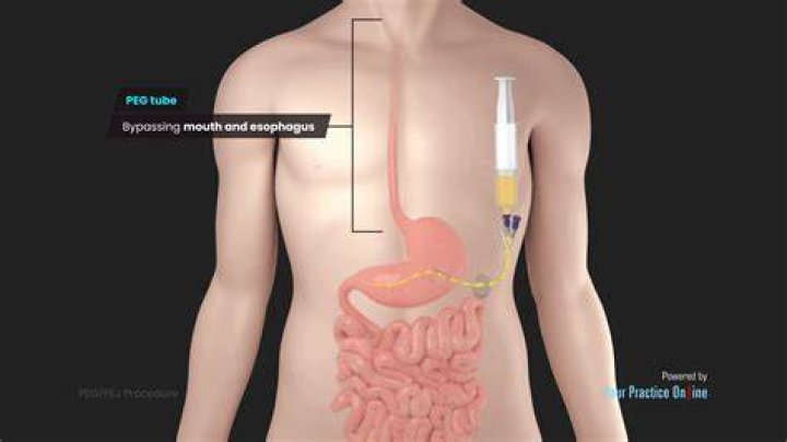 What does Pyle mean in medical terms?